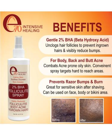 Folliculitis Treatment Spray - Salicylic Acid & Tea Tree Oil for Back Acne - Fast-Drying Solution for Men & Women - Buy Online on GoSupps.com