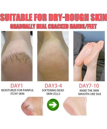  HISUNBEN Moisturizing and anti-crack foot cream with 60% urea - Cream for very dry feet - Heel balm relieves itching for dry cracked feet heels elbows and calluses. - Buy Online on GoSupps.com