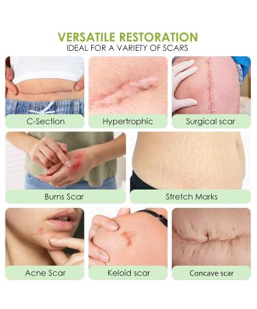 Buy AUSLKA Silicone Scar Sheets 1.6 x 120 Roll Professional Scar Tape for C-Section Tummy Tuck Keloid & Scar Treatments Fast International Shipping - Buy Online on GoSupps.com