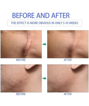 Advanced Silicone Scar Cream for Surgical Scars & Stretch Marks - 1oz - Buy Online on GoSupps.com