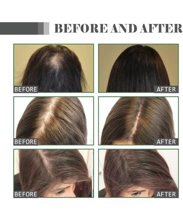 Hair Growth Serum Anti Hair Loss Hair Serum Rosemary Essential Oil With Ginseng And Castor Oil Extracts Repairs Hair Follicles Stronger Hair Hair Growth Oil for Women & Men 35ml - Buy Online on GoSupps.com