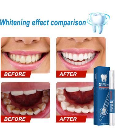 Glowbrite - Glowbrite Teeth Whitening Pen 3 Day Teeth Whitening Essence Pen Sensitive Teeth & Gums Teeth Whitening - Buy Online on GoSupps.com