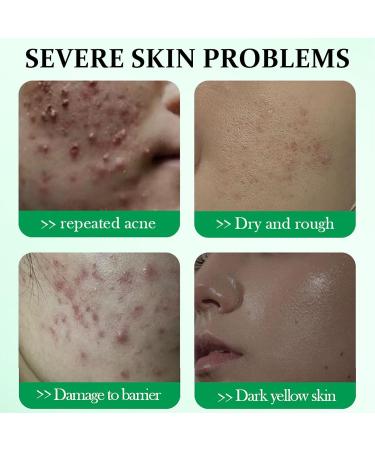 Salicylic Acid Acne Cream 50g - 3% BHA Spot Cream for Acne - Blackhead Remover - Dark Spot Remover for Face - Scar Removal Cream - Moisturizing Face Cream for Women - Pimple Cream for Redness - Buy Online on GoSupps.com