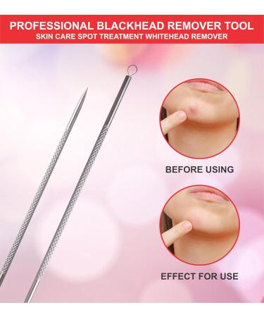 Blackhead Remover Pimple Popper Tool Pimple Extractor Popper Tool Stainless Steel Pimple Extractor Blackhead Removal Tool (Silver) - Buy Online on GoSupps.com
