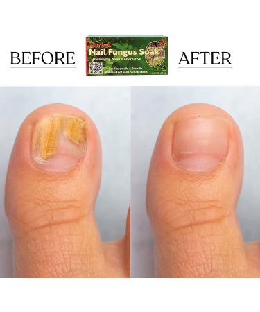 Nail Fungus Soak - Natural Solution for Toenail and Fingernail Issues - Combat Cracked Heels and Athlete's Foot - Hypoallergenic Fungus Remover for Feet and Hands - Buy Online on GoSupps.com