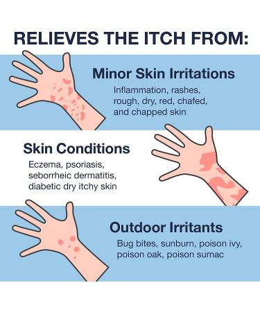 Hydrocortisone Ointment USP 1% 1.05oz - Maximum Strength Anti-Itch Relief for Rash, Allergy, Psoriasis, Eczema - Mosquito & Bug Bite Itch Relief - 4 Pack - Buy Online on GoSupps.com