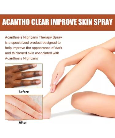 NEUKIN Acantho Clear Therapy Spray - Acanthosis Nigricans Treatment 2Count (Pack of 2) - Buy Online on GoSupps.com