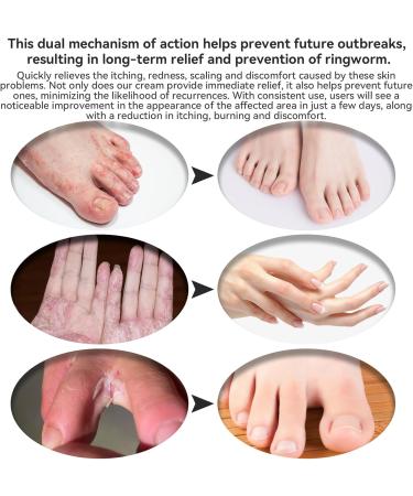 Max Strength Treat Natural Organic Manuka Honey Cream Ointment Soothing Relief for Dry Heat Rash Hidradenitis Itchy Eczema Psoriasis Leg Belly Armpit Foot Hand Irritable Skin For All Ages 4 Fl Oz (Pack of 1) - Buy Online on GoSupps.com