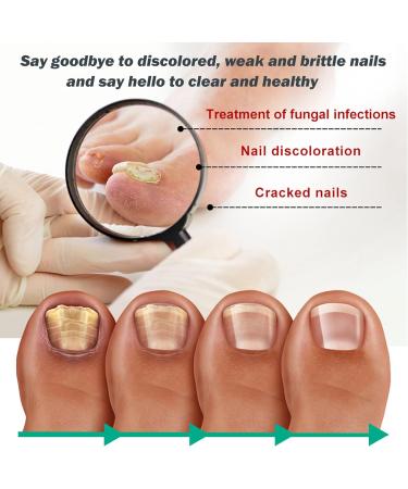 Extra Strong Fungal Nail Treatment 10ML - Toe & Finger Nail Fungus Solution - Strengthen, Repair & Renew Damaged Nails - 2Pcs - Buy Online on GoSupps.com