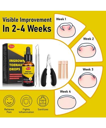 Pjordo Ingrown Toenail Treatment Kit - Includes Drops, Pain Reliever, Softener, Toe Tubes, Clipper, and File Lifter - 30ml/1oz - Buy Online on GoSupps.com