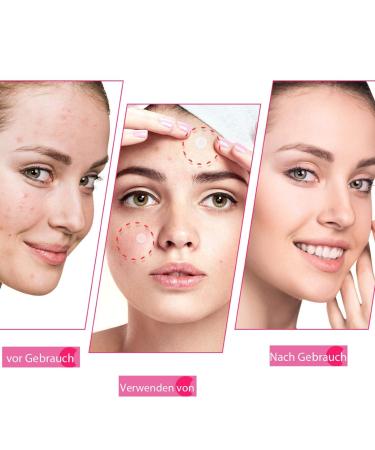 JOLVKA Acne Pimple Patch - 120 Hydrocolloid Plasters for Acne & Pimples - Effective Spot Treatment - Buy Online on GoSupps.com