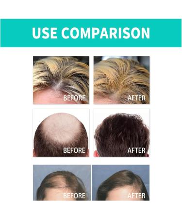 NMN HAIR GROWTH ROLLER - Buy Online on GoSupps.com