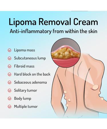 Lipoma Removal Cream Cr me Naturelle d' limination des Lipomes Pommade Apaisante pour Les Lipomes Pommade de Suppression s re Utiliser pour Les Gros Morceaux 20g*2pc - Buy Online on GoSupps.com