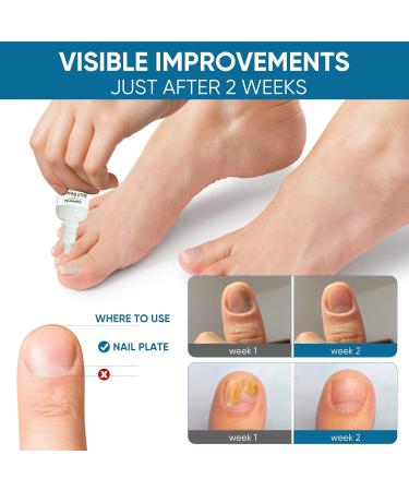 Extra Strength Nail Repair Drop for Toenail Fungus Treatment - Restores Appearance of Discolored Nails - Natural Herbal Extract - 1 Count - Buy Online on GoSupps.com