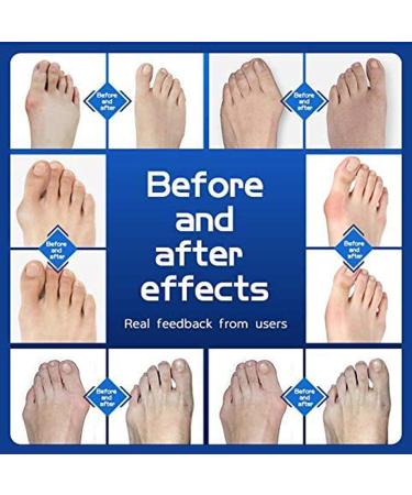 Pack of 8 Gel Toe Separators - Toe Spacers for Overlapping Toes, Crooked Toe Correction, Bunions, Hallux Valgus - Beige - Buy Online on GoSupps.com