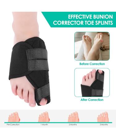 Kireina Bunion Relief Corrector - Nighttime Toe Separator for Hallux Valgus Overlapping Toes & Turf Toe Pain Relief - Buy Online on GoSupps.com