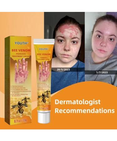 HAAB Youth Bee Venom Psoriasis Treatment Cream - Skin & Scalp Relief - 2pcs - Buy Online on GoSupps.com
