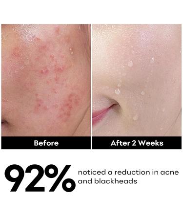 Salicylic Acid Face Cleanser | Daily Acne Wash for Oily & Sensitive Skin | 5.07 FL OZ - Remove Blackheads & Breakouts - Buy Online on GoSupps.com