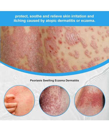 2pcs 30ml Psoriasis Relief Solution Spray for Skin - Itch Relief & Exfoliation Treatment - Buy Online on GoSupps.com