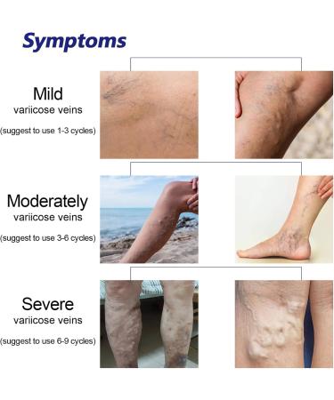 Xiyinli 30 ml Non-Toxic Varicose Vein Spray Relieves Swelling & Pain Improves Circulation - Buy Online on GoSupps.com