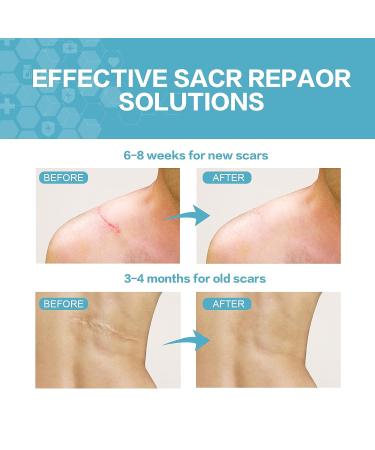 Medical Grade Silicone Scar Sheets Roll - 1.6 x 120 inches, 3M Brand - For C-Section, Surgery, Burn, Keloid, Acne - Reusable & Washable - Scar Removal Treatment - Buy Online on GoSupps.com
