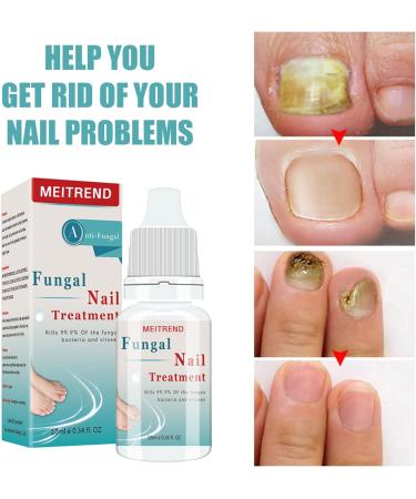 Fungal Nail Treatment | Strengthens Toenails | Toe Nail Fungus Solution - Buy Online on GoSupps.com