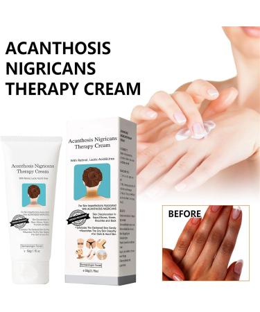 Mikabila (04) Acanthosis Nigricans Cream Face and Body Whitening Cream Skin Lightening Cream for Dark Skin Underarm Whitening Cream Effective for Armpit Knees Elbows & Knuckles - Buy Online on GoSupps.com