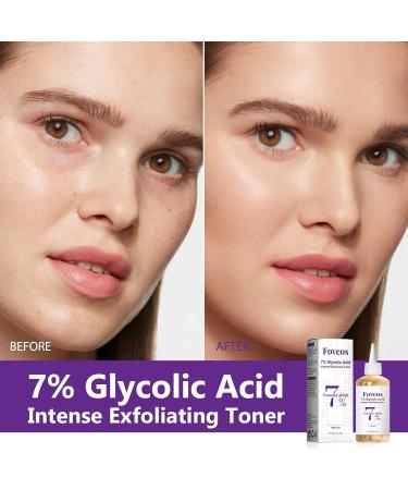 7% Glycolic Acid Exfoliating Toner Exfoliating Skin Care Facial Toner Improves Texture Reduces Breakouts Pores and Fine Lines Suitable for All Skin Types 8.44 Fl Oz (Pack of 1) - Buy Online on GoSupps.com