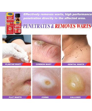 Wart Remover Liquid | Maximum Strength Gel Mask for Plantar & Common Warts | Safe & Natural Formula - Buy Online on GoSupps.com
