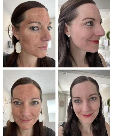 Jessner Solution Acid Peel 20% 1oz. 30ml (Level 2 pH 1.9) - Exfoliating (FREE Neutralizer 100ml) - Buy Online on GoSupps.com