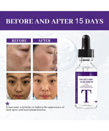 Tranexamic Acid Serum Tranexamic Acid Face Serum Brightening Serum for Face Dark Spot Remover for Face Txa Dark Spot Correcting Serum Reduces Hyperpigmentation Anti Wrinkle Hydrating - Buy Online on GoSupps.com