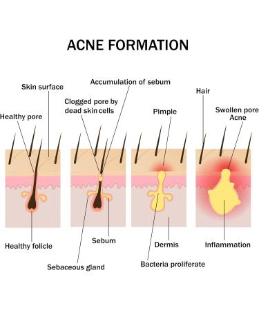 Wellmadefairtrade Herbalshire Sulphur Cream Natural Sulphur Ointment Cream Sulphur Acne Sulphur Body Cream 35g - Buy Online on GoSupps.com