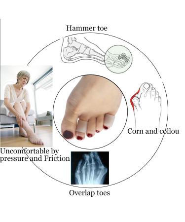 5 Pairs Pinky Toe Sleeve - Hammer Toe & Bunion Protection Corn Remover Callus Cushion Toe Tubes for Friction Relief - Buy Online on GoSupps.com