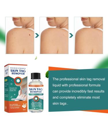Skin-Tag-Remover Kit Remover for Verruca-Treatment - 30ml - Buy Online on GoSupps.com