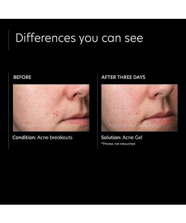 PCA SKIN Acne Spot Treatment Gel - 2% Salicylic Acid for Breakouts & Dark Spots - 1 fl oz - Buy Online on GoSupps.com