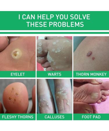 WATSKY Skin softening and foot care fluid for removing warts and corns gentle hypoallergenic formula 10 ml pack of 3 - Buy Online on GoSupps.com