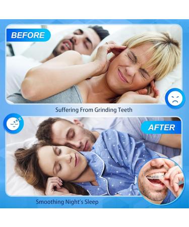 IUFDGHN 4 Pieces of alveolar bruxism BPA Free thermoplastic Safety Materials Oral Protectors Dental bruxism Protectors Nighttime Dental Protectors -2 Sanitary Boxes - Buy Online on GoSupps.com