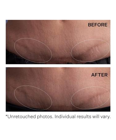 StriVectin Anti-Wrinkle SD Advanced Plus - Intensive Moisturizing Concentrate for Wrinkles & Stretch Marks, 2 Fl Oz - Buy Online on GoSupps.com