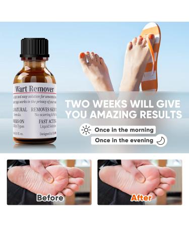 WABRINY Wart Remover Liquid: Fast-Acting Gel for Plantar Wart, Flat Warts, and Corns - Gentle Skin Smoothing Formula - Buy Online on GoSupps.com