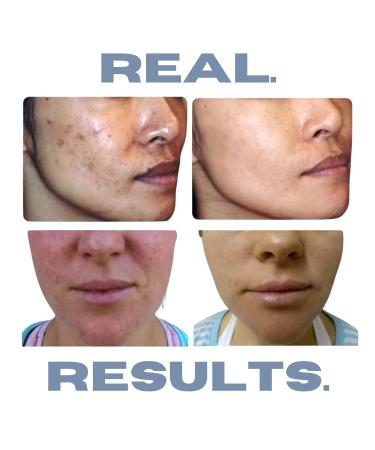 Hormonal Acne Solution | Natural Anti-DHT Benzoyl Peroxide Formula | 1 Month Original Benzoyl Kit - International Shipping - Buy Online on GoSupps.com