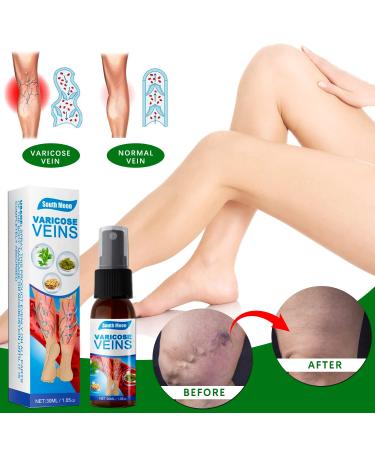 2 Pieces Veinhealing Varicose Vein Treatment Spray | Soothing Relief for Legs | Effective Varicose Vein Spray - Buy Online on GoSupps.com