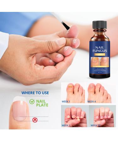 Extra Strength Toe Nail Fungus Treatment - Effective Nail Repair Solution for Healthy Nails - Buy Online on GoSupps.com