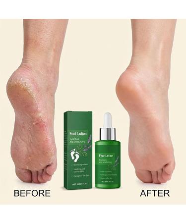 Foot Lotion | Heel Moisturizing Lotion 30ml | Intensive Foot Moisturizer Daily After-Shower Care for Dry Winter Climates and Travel - Buy Online on GoSupps.com