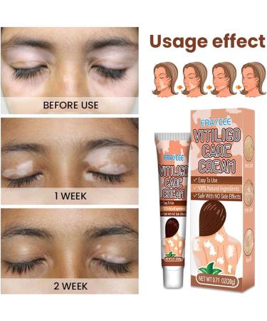  Hongjingda Skin lightening cream for vitiligo - 20g vitiligo relief cream for white patches on the skin reduces white patches improves epidermal melanocytes Hongjingda - Buy Online on GoSupps.com