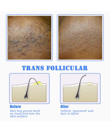 TailaiMei Exfoliating Brush - Ingrown Hair & Bikini Bump Treatment - Smooth Skin Solution for Men & Women - Buy Online on GoSupps.com