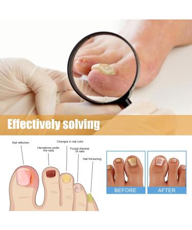 Fungal Nail Treatment Nail Repair Patches Restores Damaged Nails Nail Fungus Treatment for Toenail Gently Effectively Nail Care Anti Fungal Repair Patches Restores Healthy Nails - Buy Online on GoSupps.com