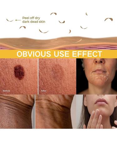 Exfoliating Acanthosis Peeling Oil Exfoliation Body Oil Peeling Solution Skin Peel Dark Spot Corrector Oil Yellow Peeling Oil Body Skin Care Exfoliation Oil Dark Spot Remover For Body Hand Feet - Buy Online on GoSupps.com