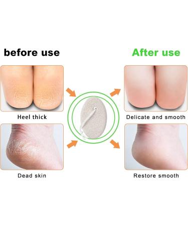 Uoking Pumice Stone for Feet - 2 PCS Natural Lava Scrubber & Callus Remover - Buy Online on GoSupps.com