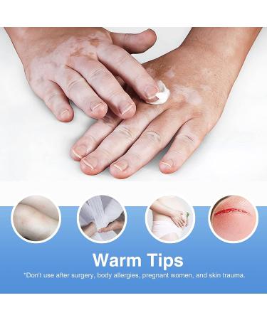 Vitiligo Cream for Skin Pigmentation | Reduce White Spots Treatment - Buy Online on GoSupps.com