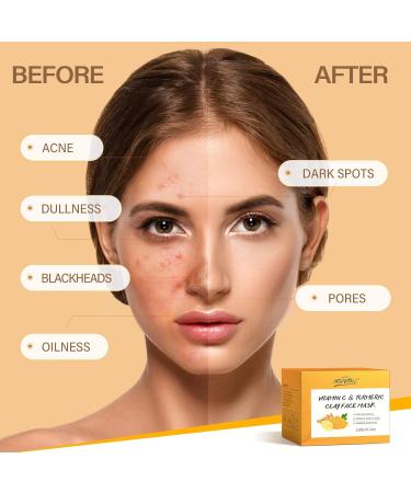 Kurkuma Vitamin C Tone Mask | Deep Cleansing Face Mask for Acne Blackheads & Dark Spots | Refines Pores & Evens Skin Tone - Buy Online on GoSupps.com